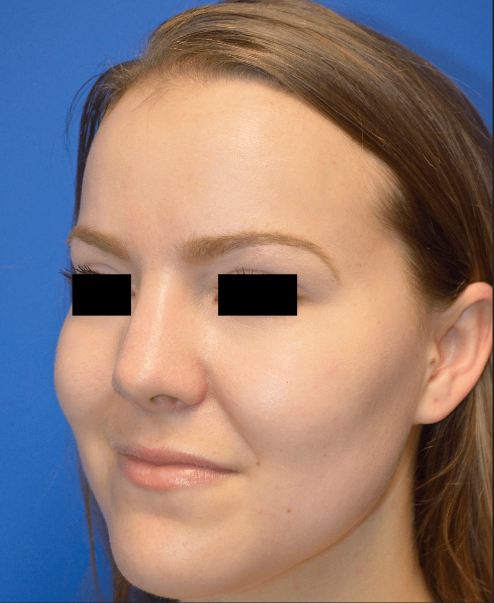 Rhinoplasty: Angle After