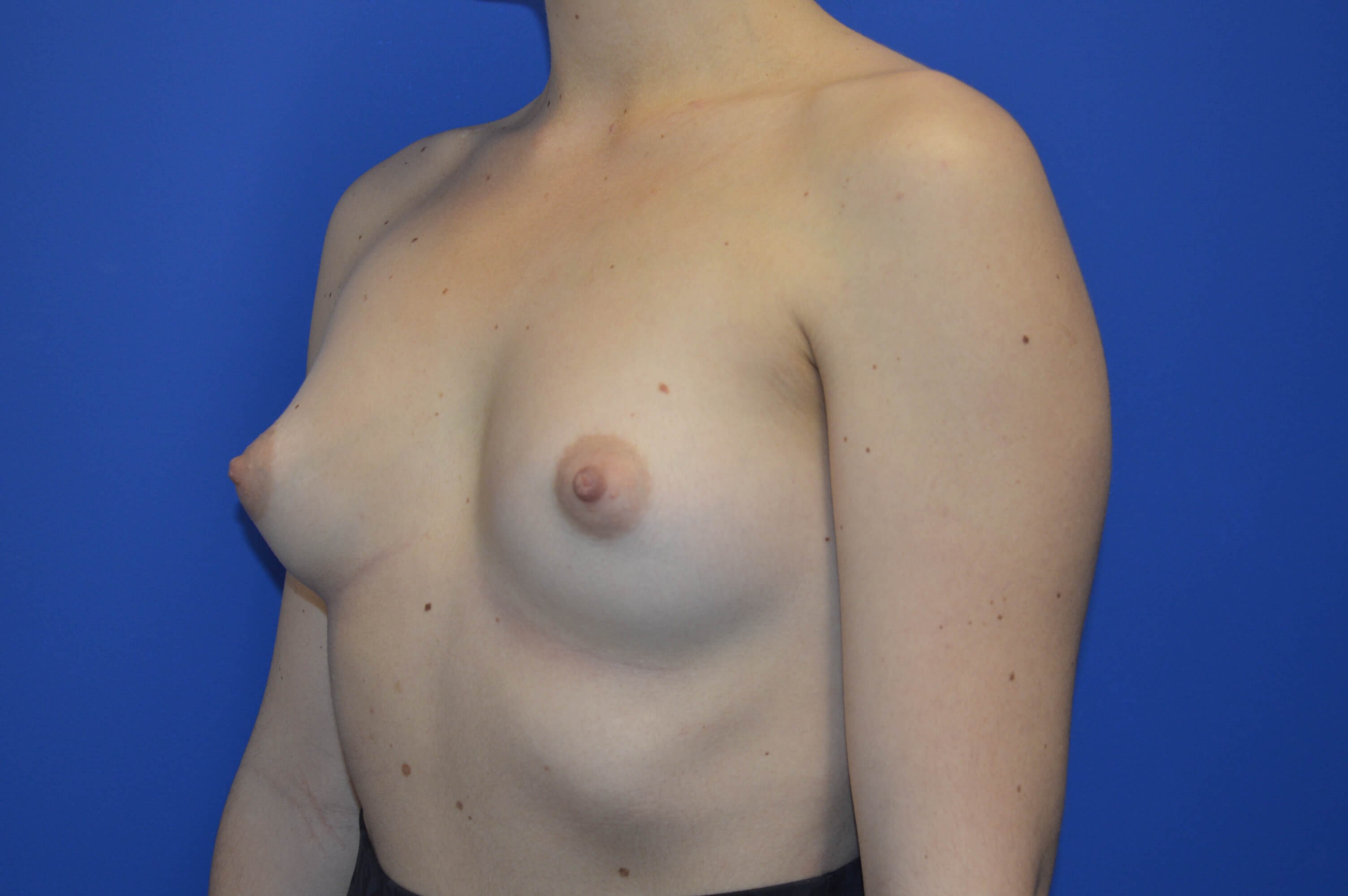 Breast Augmentation: Angle Before