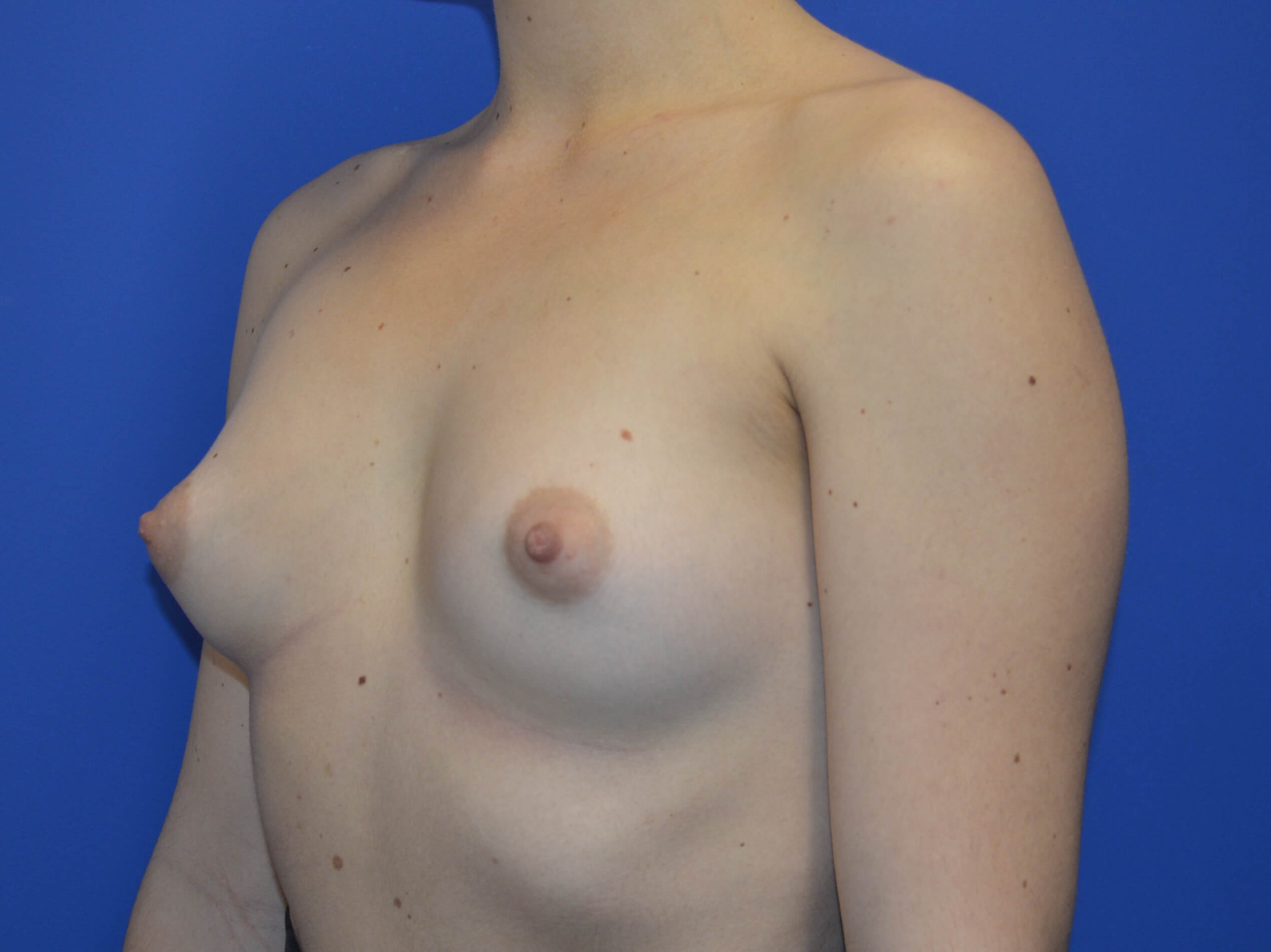 Breast Augmentation: Angle Before