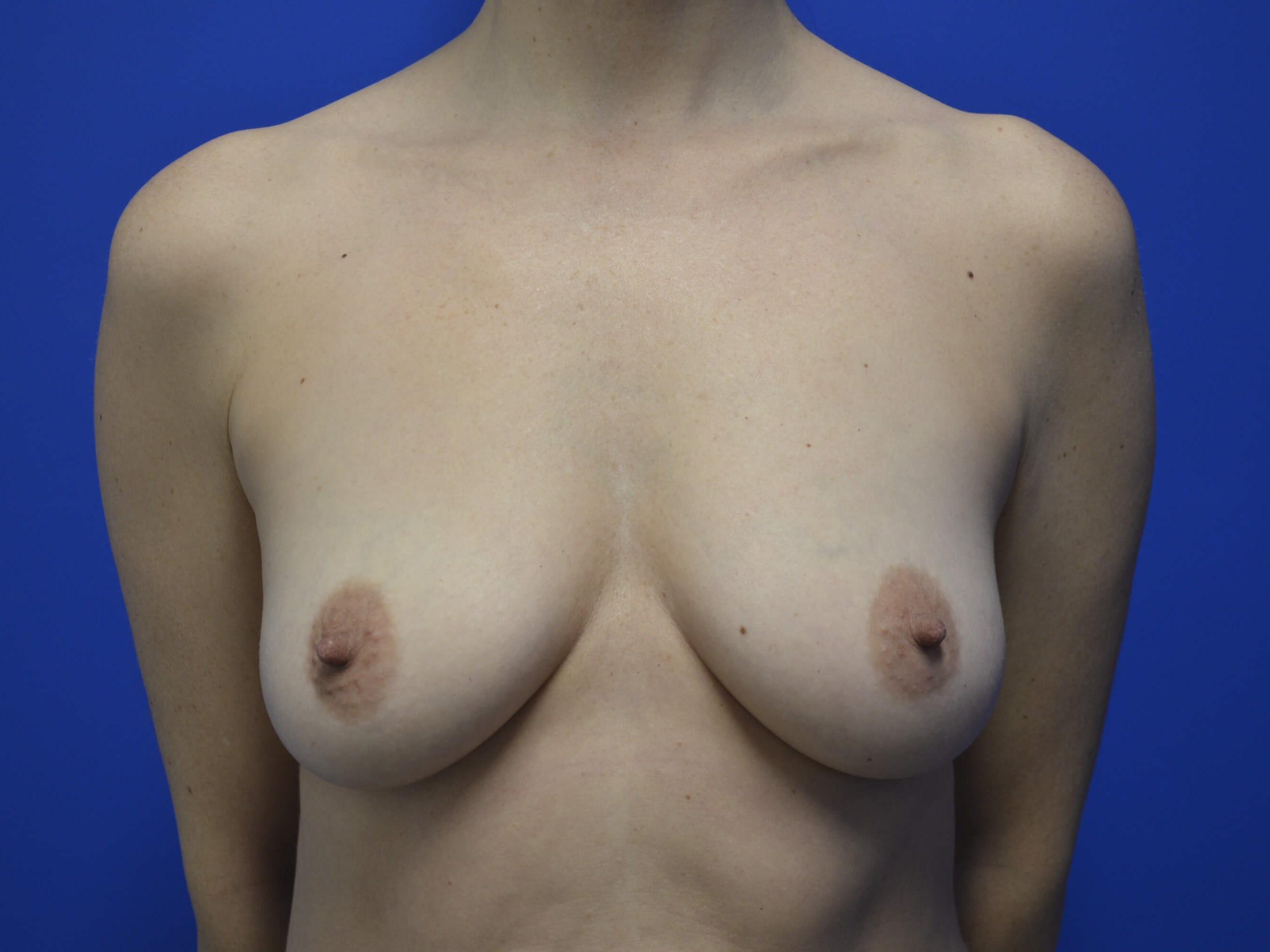 Breast Augmentation: Front Before
