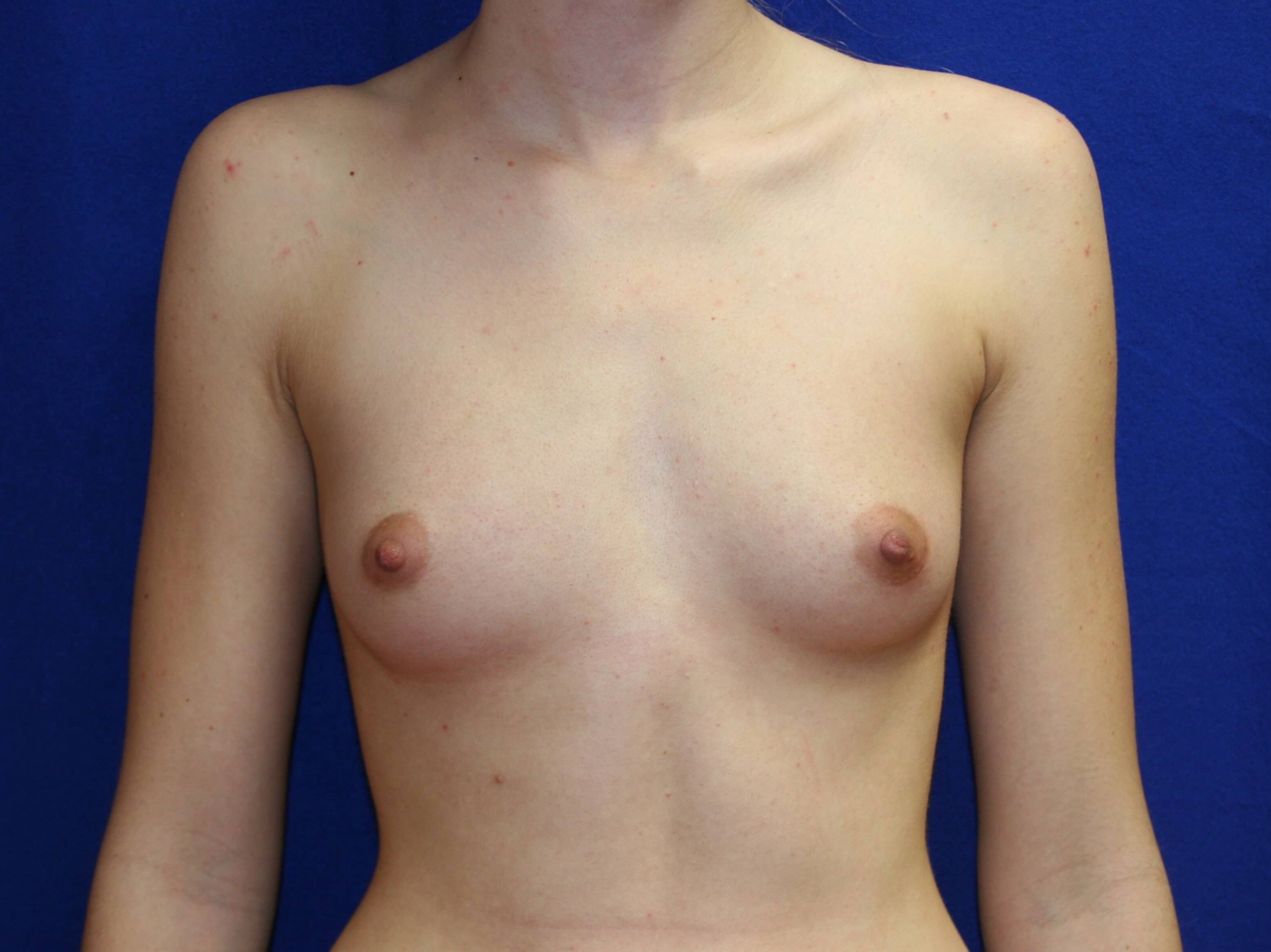 Breast Augmentation: Front Before