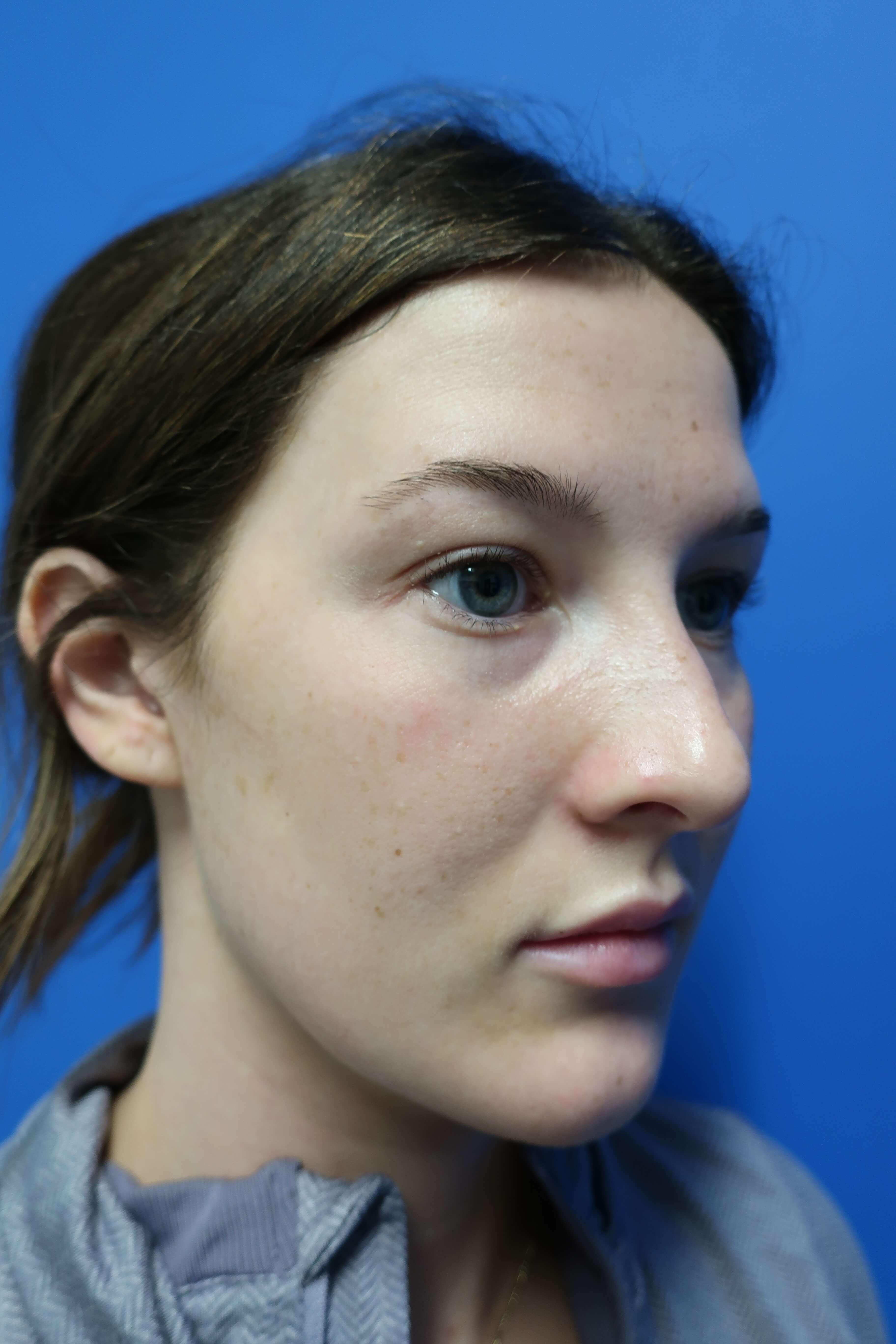 Rhinoplasty: Angle Before
