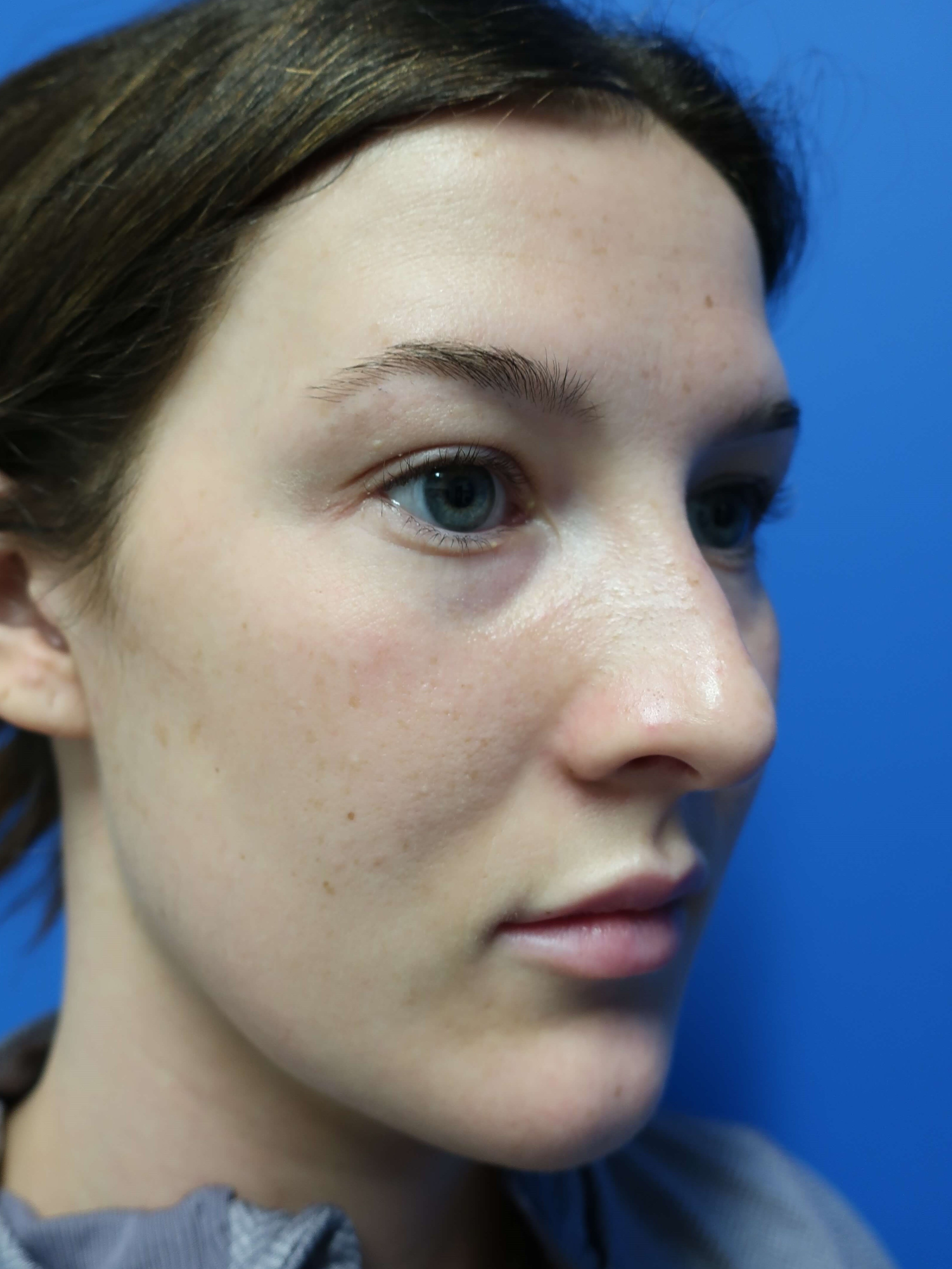 Rhinoplasty: Angle Before