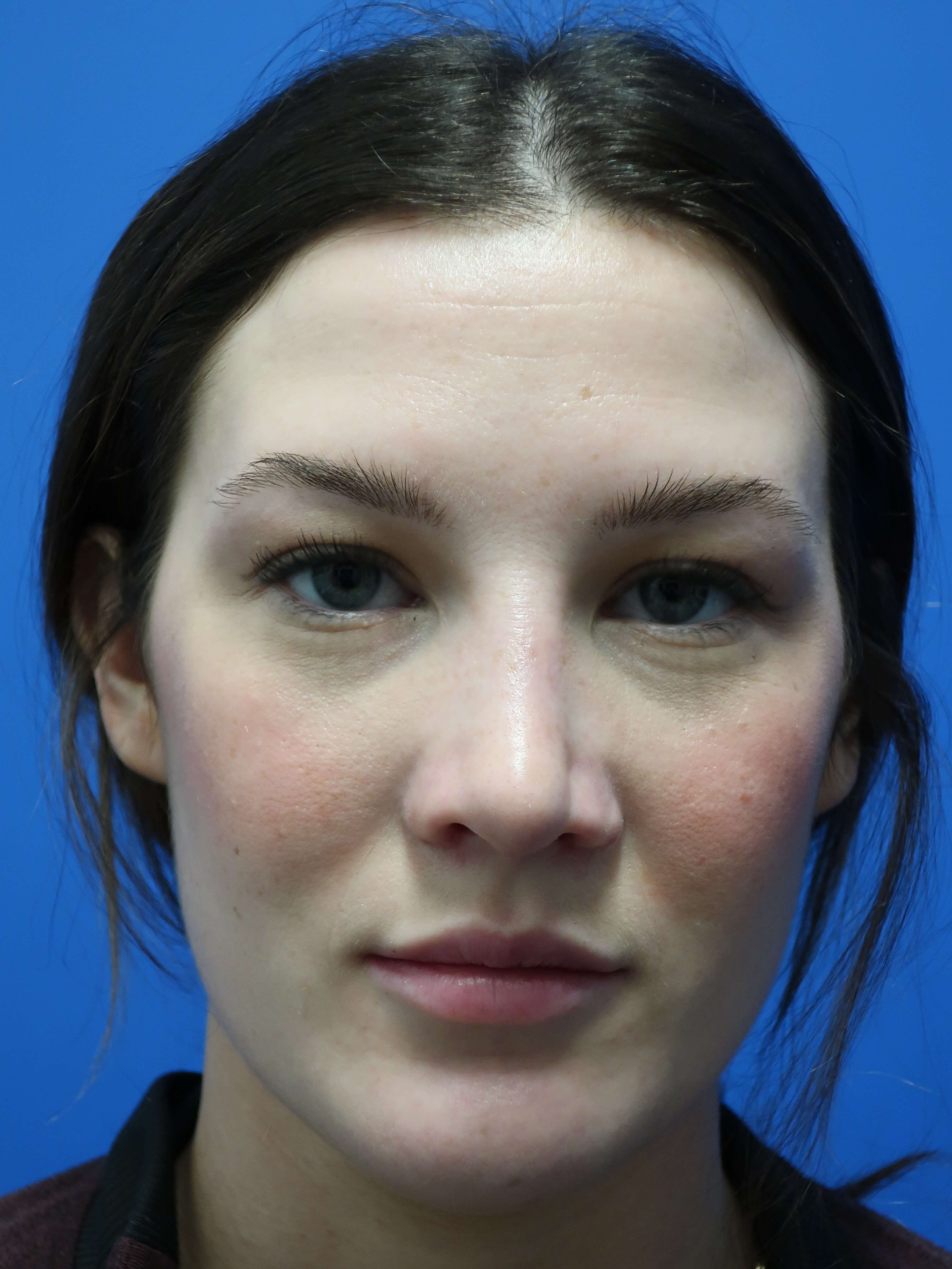 Rhinoplasty: Front After