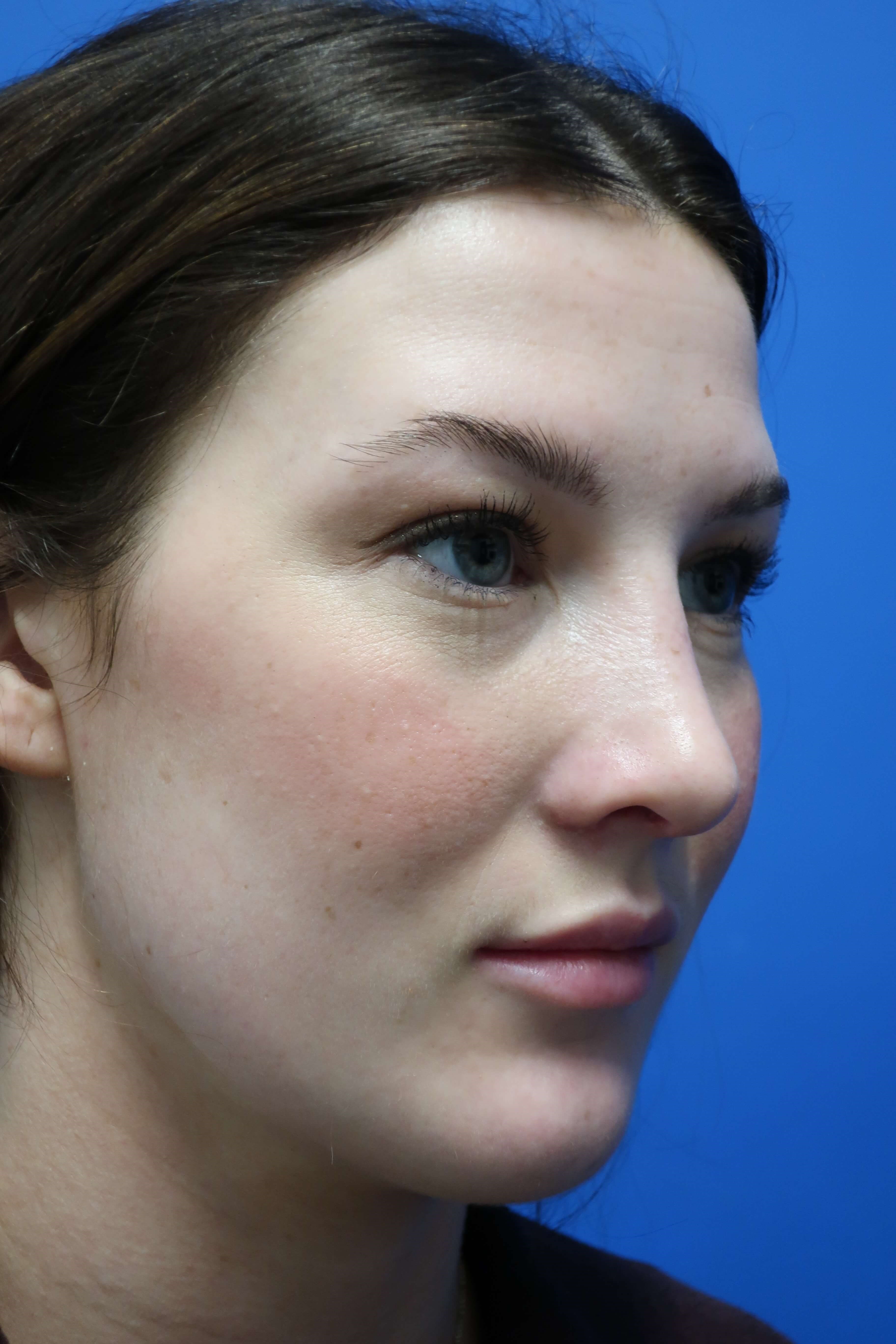 Rhinoplasty: Angle After