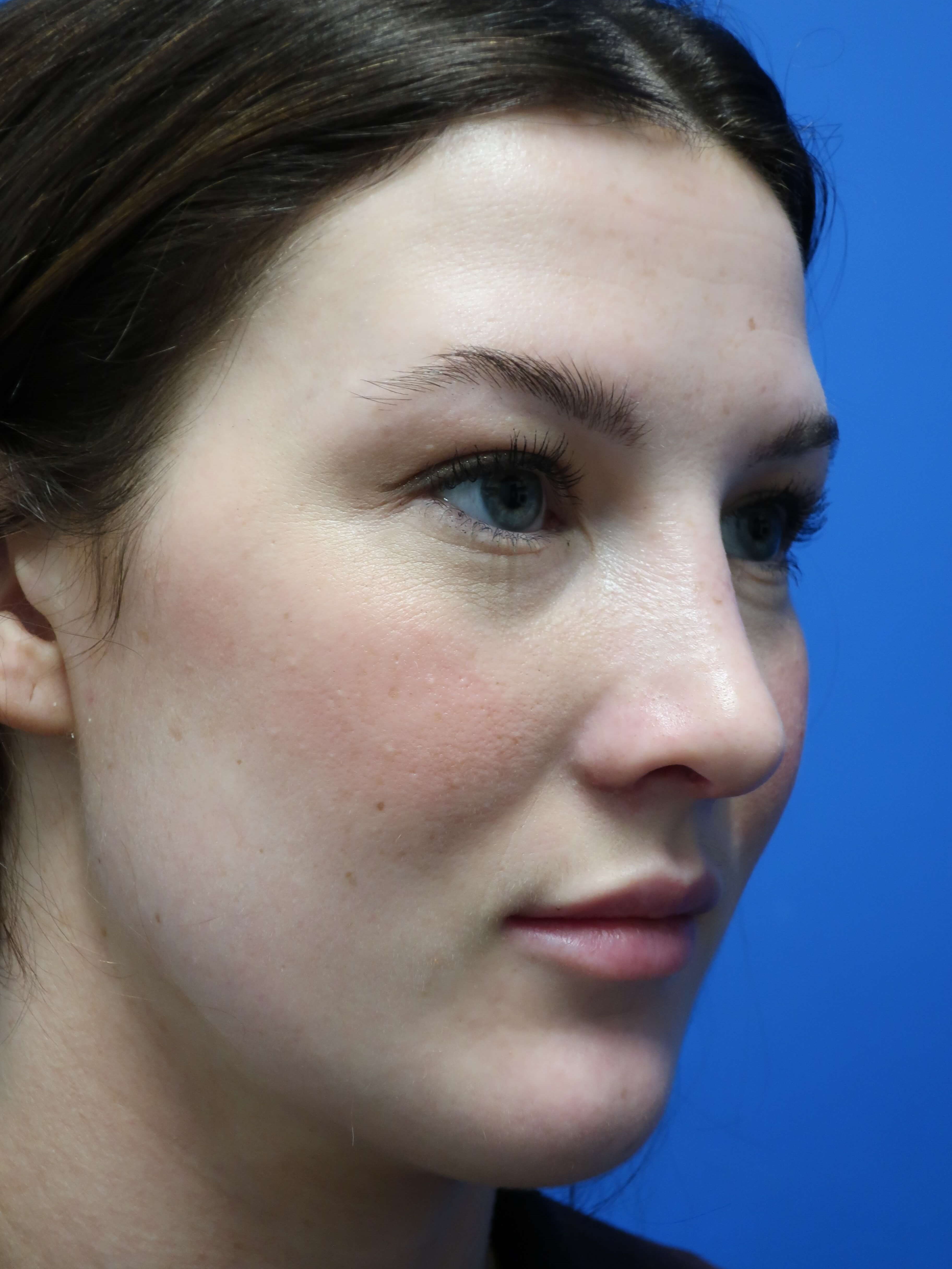 Rhinoplasty: Angle After