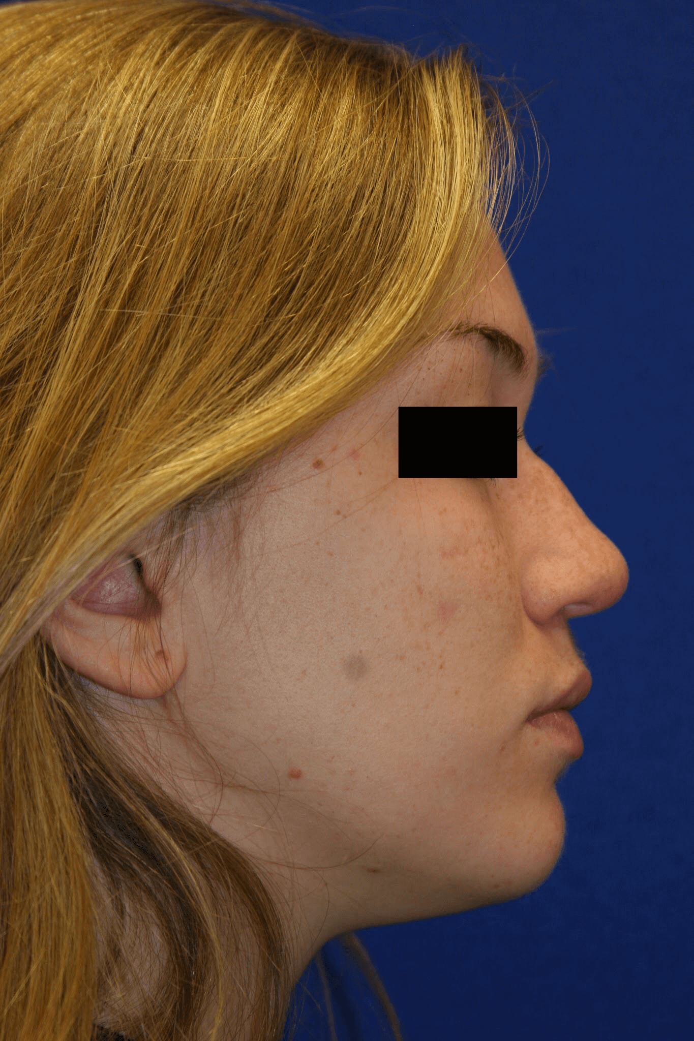 Rhinoplasty: Profile Before