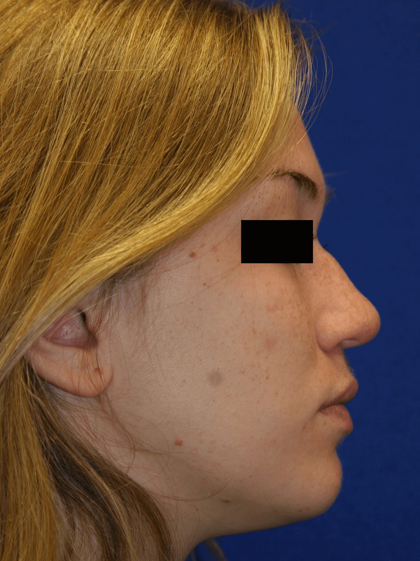 Rhinoplasty: Profile Before