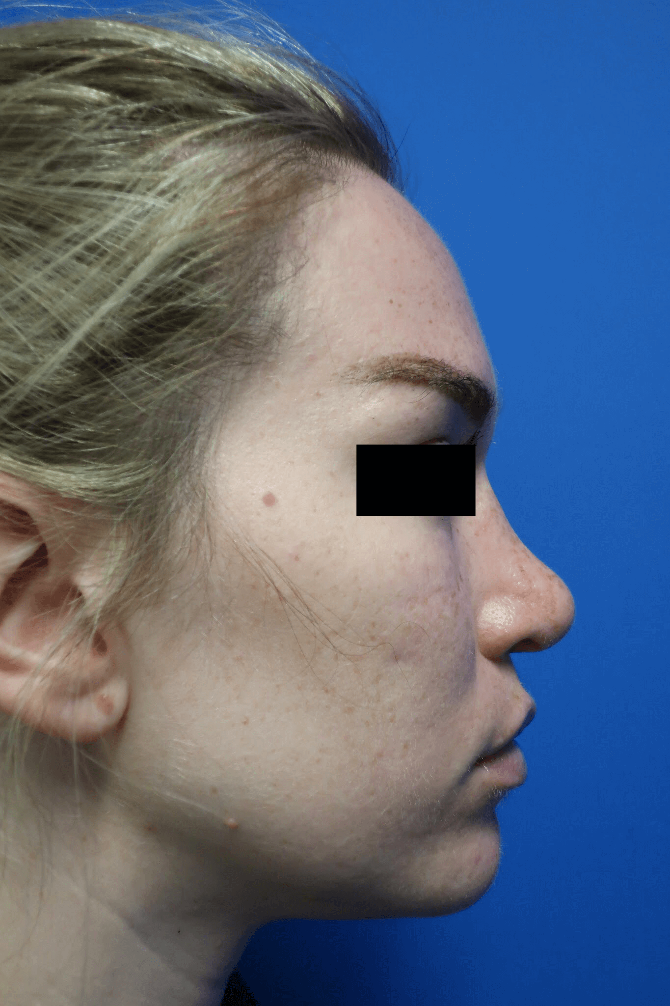 Rhinoplasty: Profile After