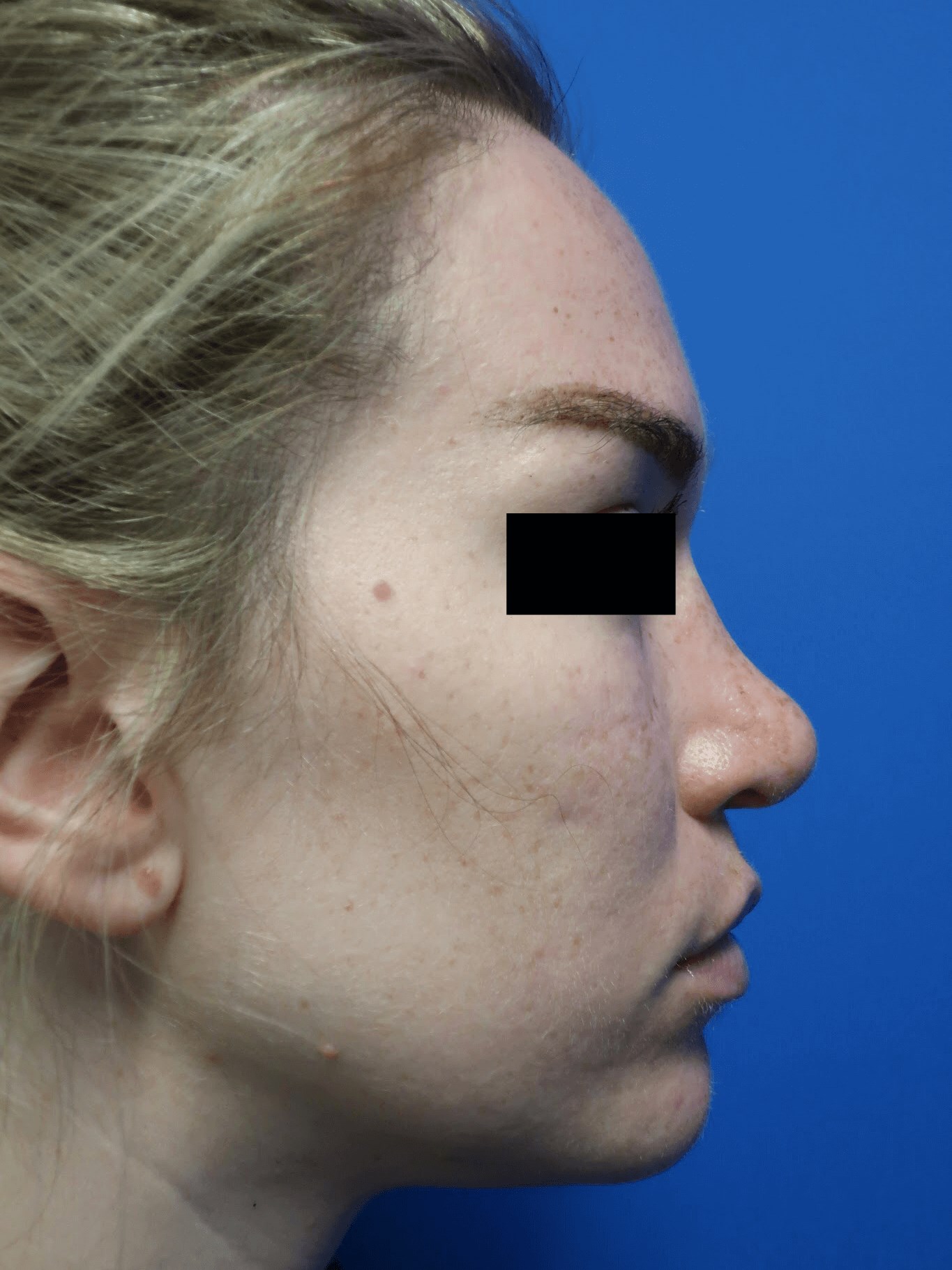 Rhinoplasty: Profile After