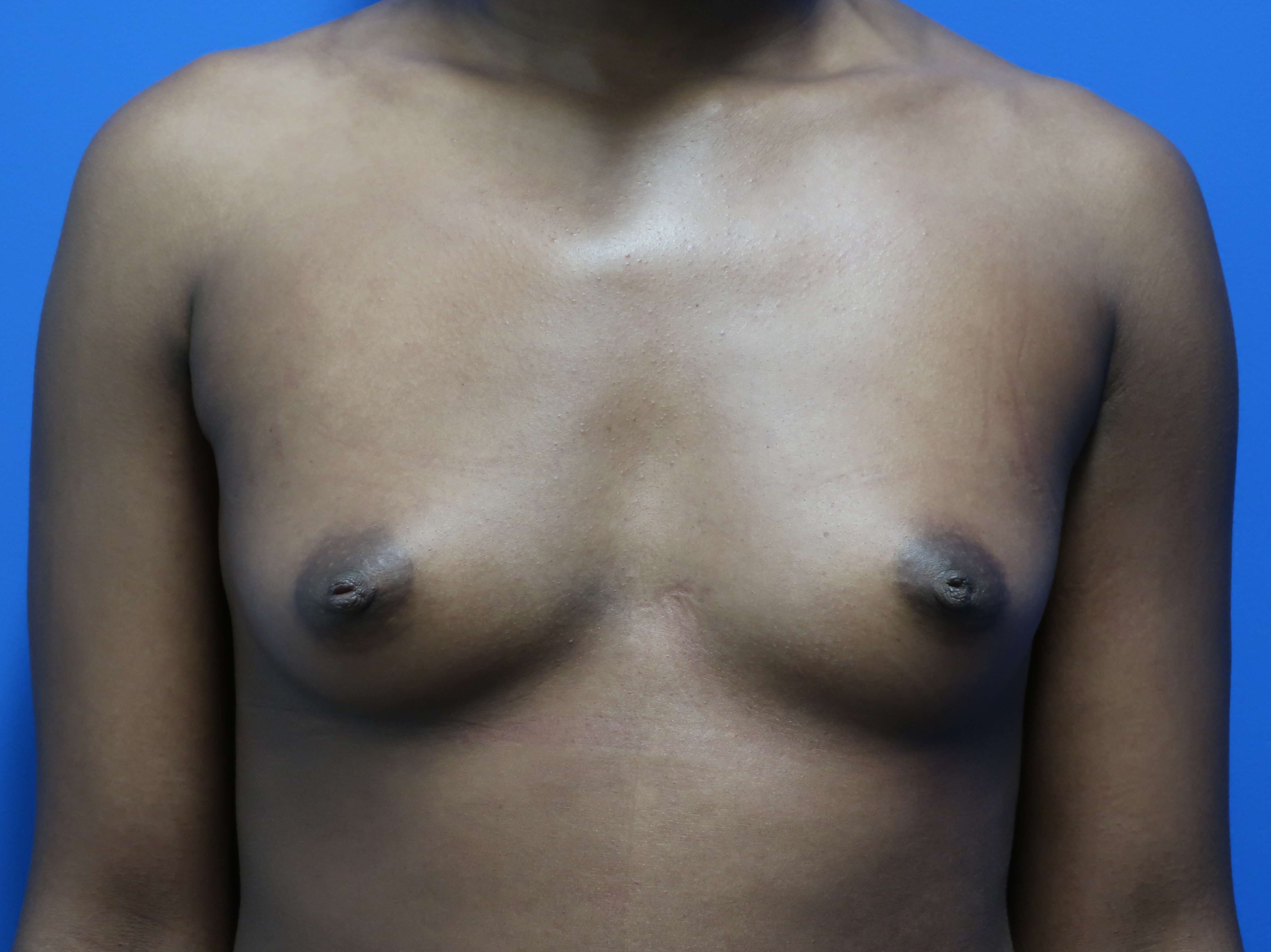 Breast Augmentation Before