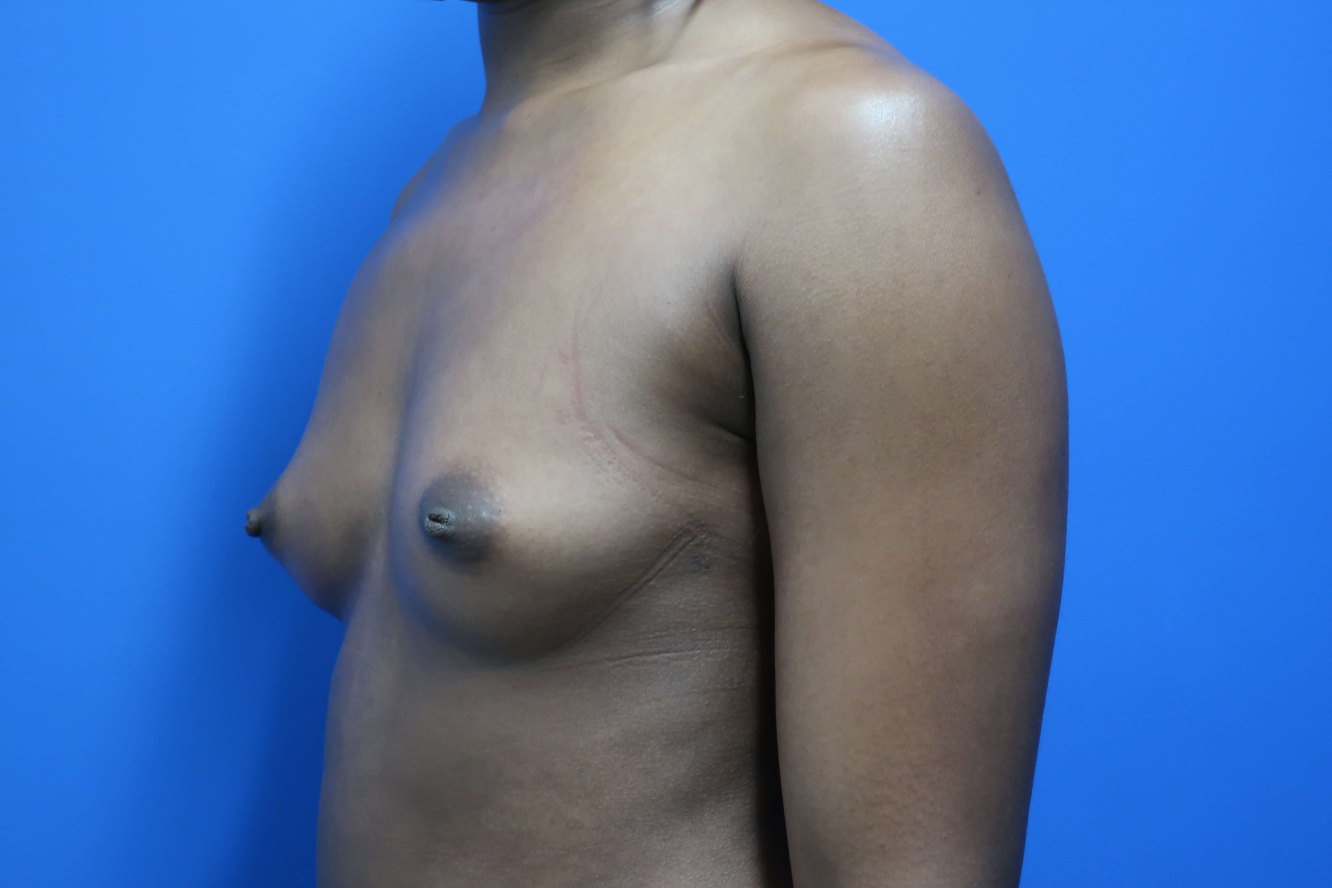 Breast Augmentation: Angle Before