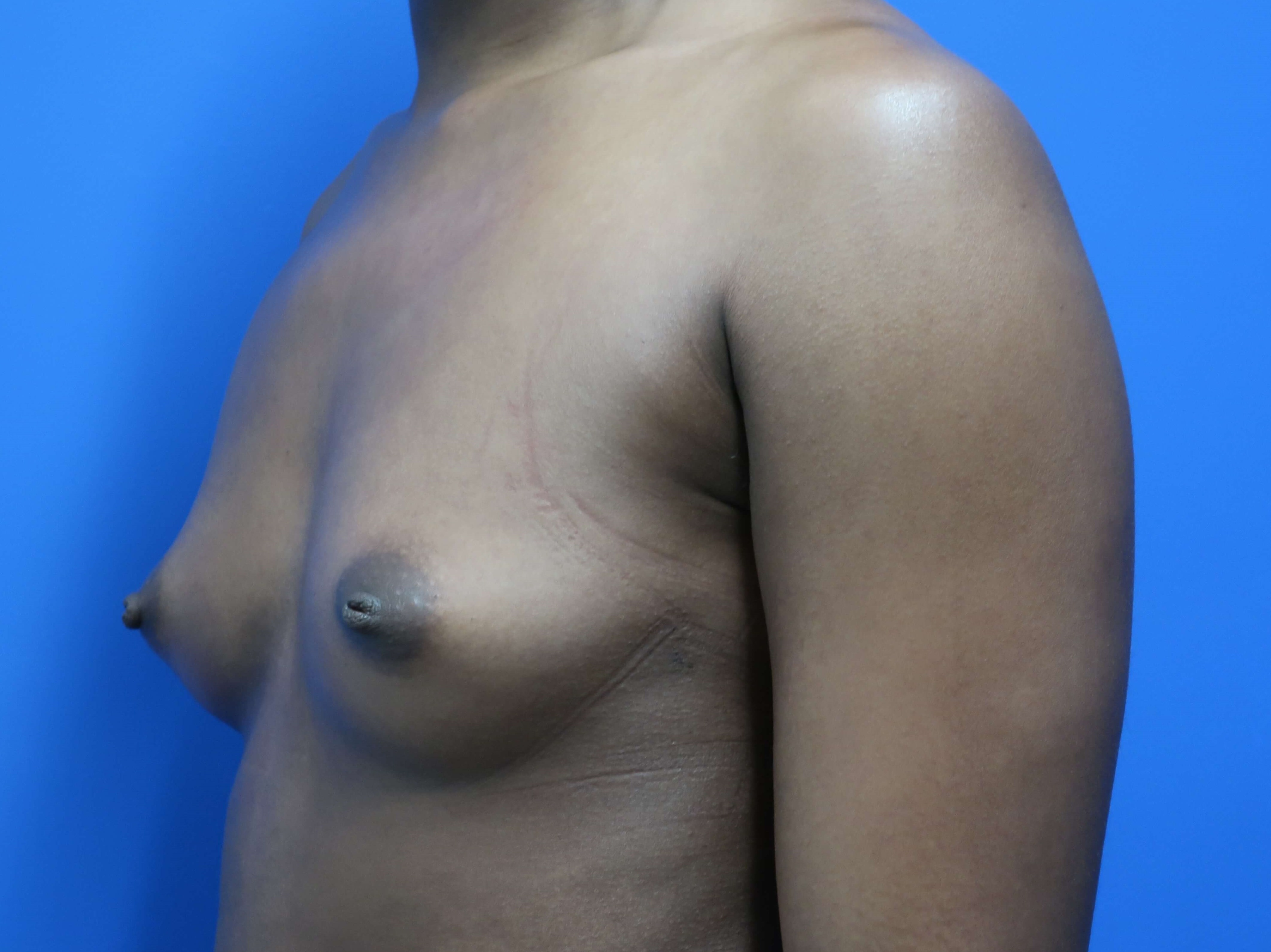 Breast Augmentation: Angle Before