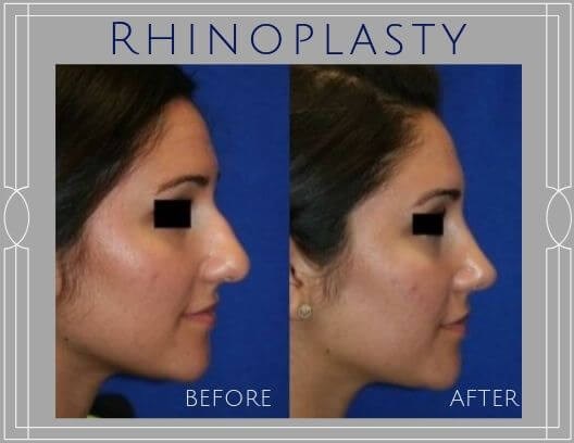 Attractive upturned nose Rhinoplasty Journey: