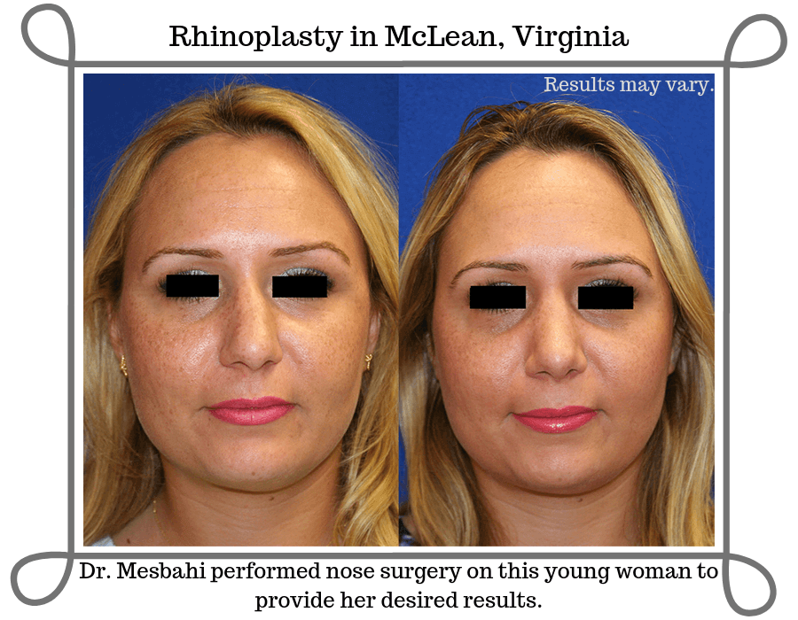 Upturned Nose: Do You Need to Correct It?