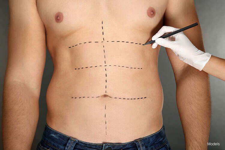 Will You Get Better Looking Abs With A Tummy Tuck?