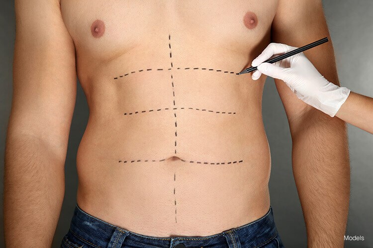 Get Toned Abs With Tummy Tuck Surgical ProcedureGet Toned Abs With Tummy  Tuck Surgical Procedure